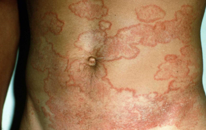 Аллергия на животе сыпь фото thumbnail