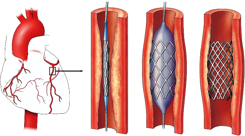 Стентирование сердечных сосудов 
