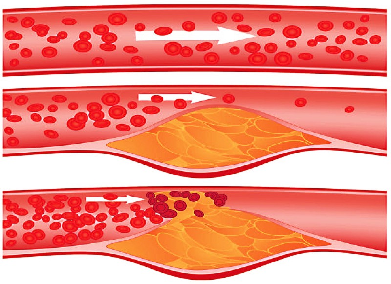 Атеросклероз артерий 
