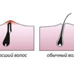 Схема вросшего волоска