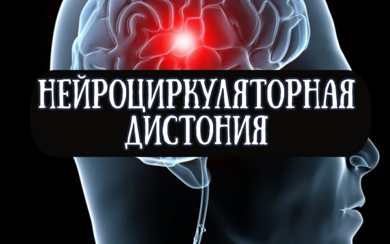 Нейроциркуляторная дистония (НЦД) 