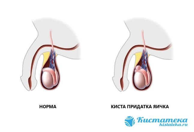 Сперматоцеле возникает от нарушения выработки и оттока секрета по придаткам
