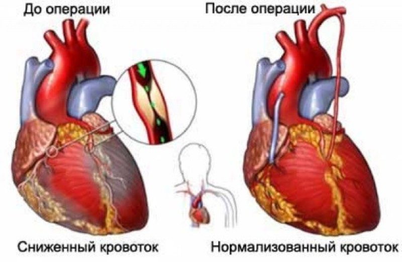 Работа сердца до и после операции 