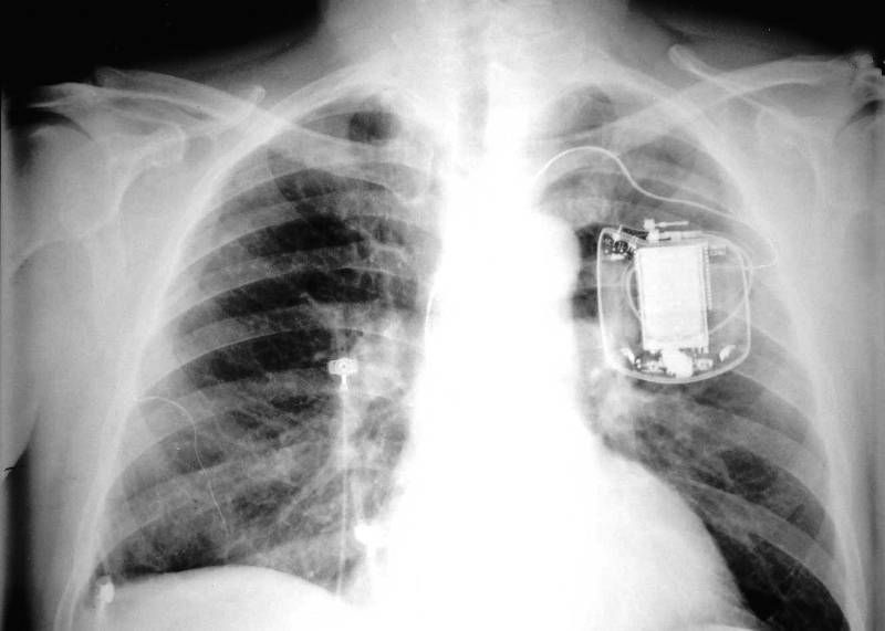 Имплантируемый дефибриллятор на рентгене 