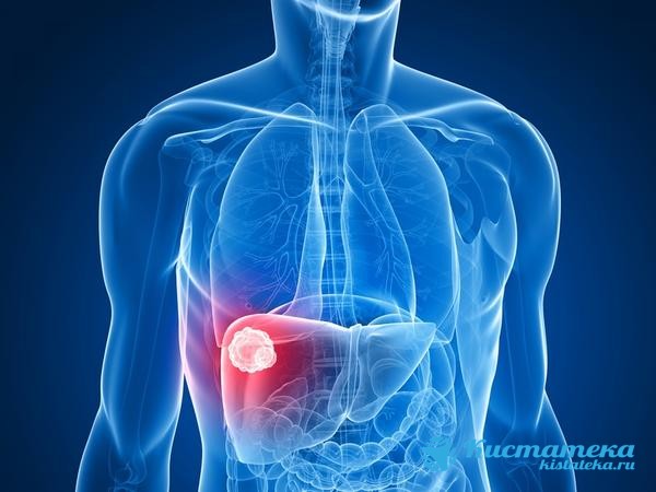 Паразитарная опуоль возникает вследствие внедрения гельминтов в ткани органа