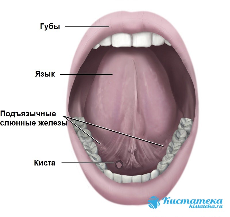 Под корнем языка появляется доброкачественная опуоль арактерной округлой или овальной формы