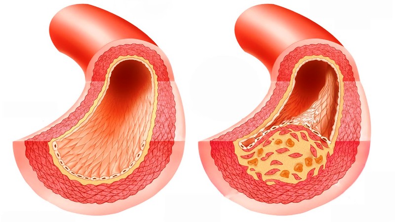 Здоровая и атеросклеротическая артерии 