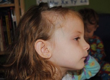 лечение выпадения волос у ребенка