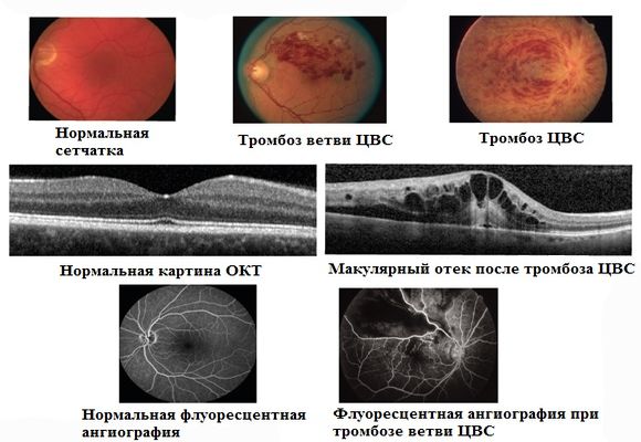 Диагностика тромбоза глаза