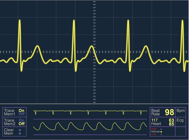 Нарушение сердечных ритмов заметны на ЭКГ