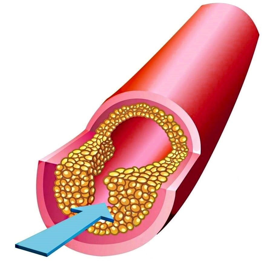 Разрушение целостности эндотелия приводит к формированию тромбов на участках повреждения