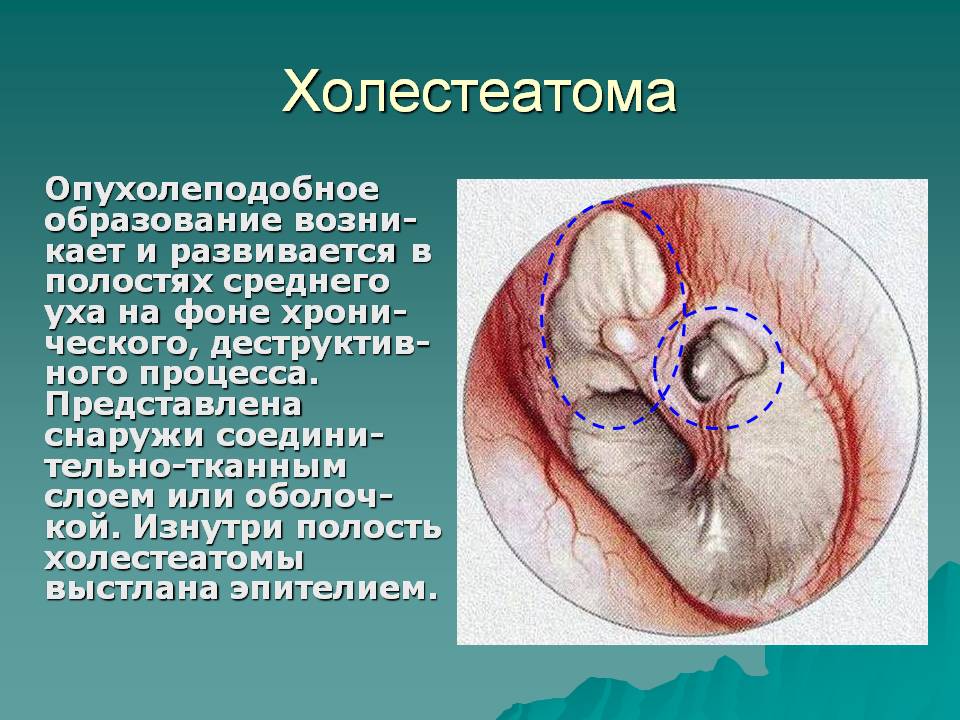 Наиболее часто холестеатома формируется в среднем ухе