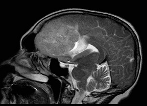 томография головного мозга