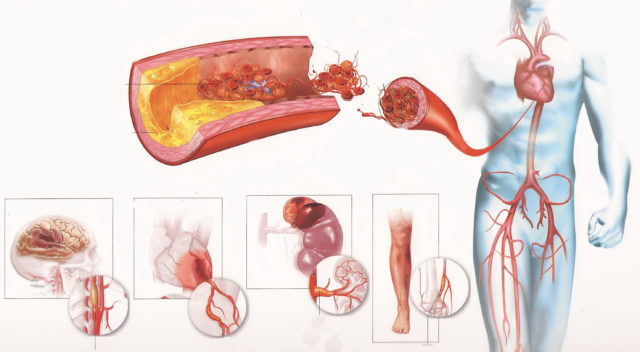 Атеросклеротические изменения способствуют отложению внутри сосудов излишков жира, и постепенно просвет кровеносной трубки сужается