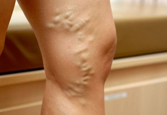 проявление варикоза на ноге