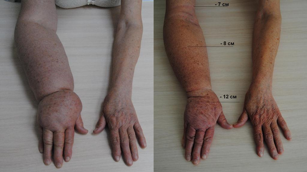 Лечение 2 стадии лимфостаза рук