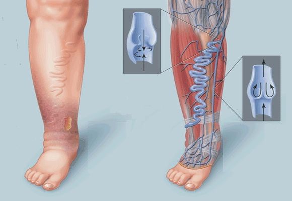 Тромбоэмболия ног