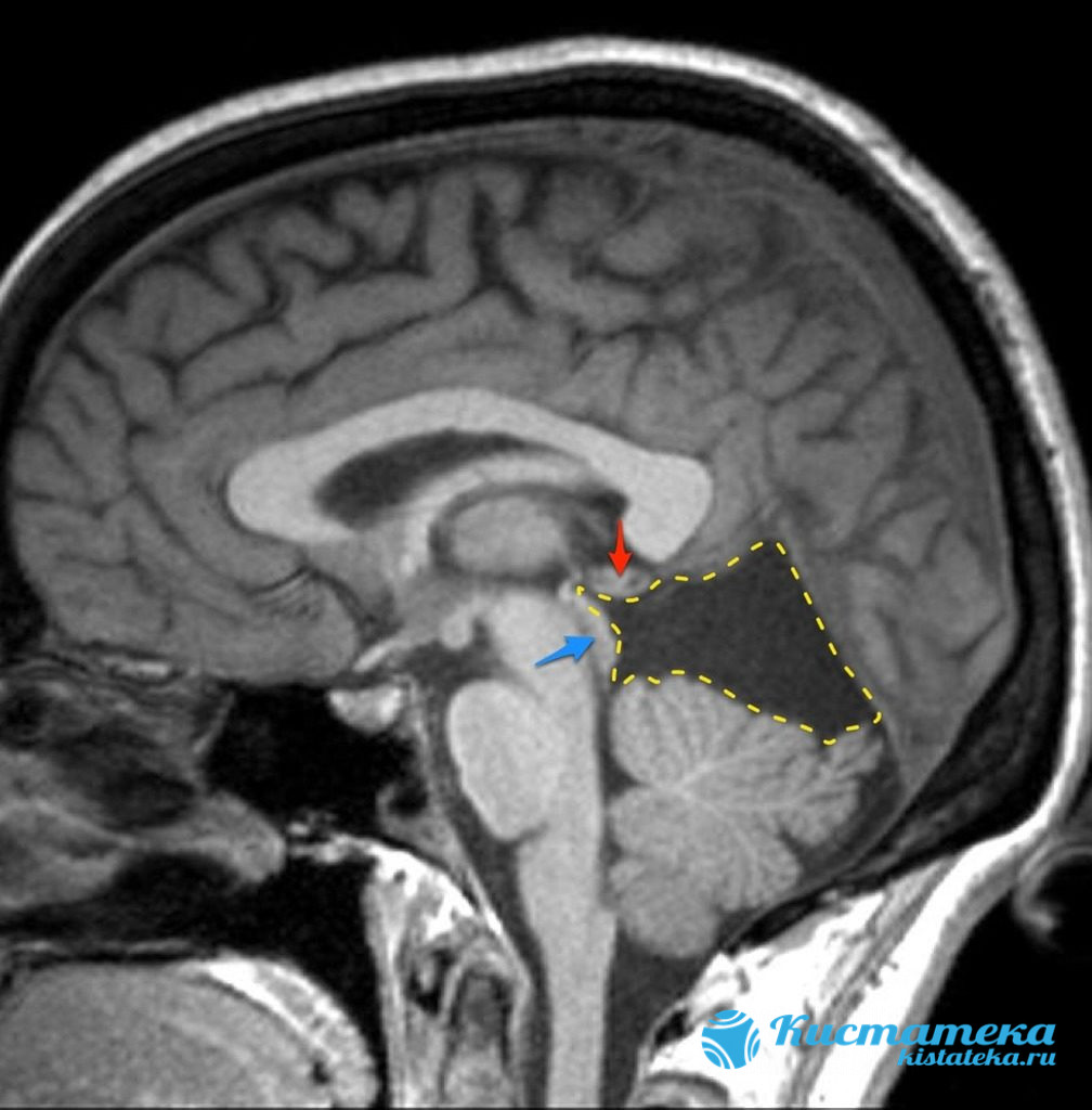 Патология располагается между крышей мозга (синяя стрелка) и шишковидной железой (красная стрелка)