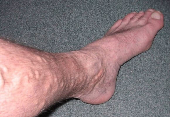 Узлы на венах ног при варикозном заболевании