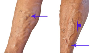 Повышение болевых симптотов и появления узелков на ногах
