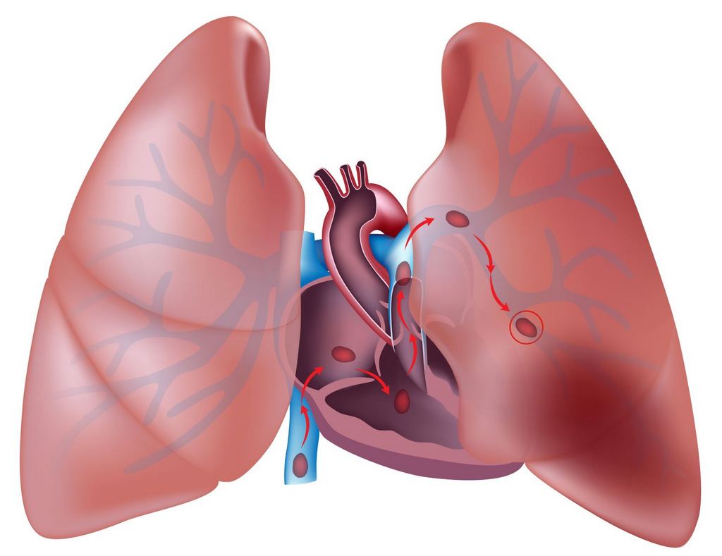 Тромбоэмболия лёгочной артерии 