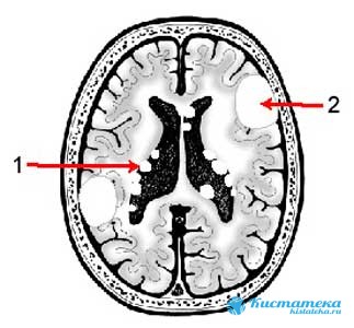 Мелкая полость со спинномозговой жидкостью расположена сразу под корой головного мозга из-за повреждения сосудов