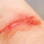 Противопоказание лазера при повреждениях кожи